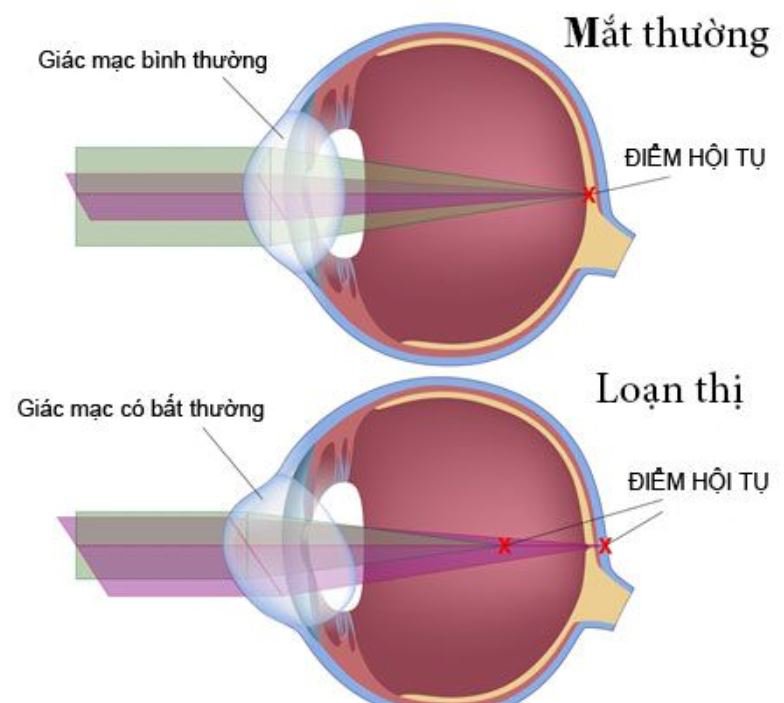 Phân biệt cận thị và viễn thị chính xác đơn giản tại nhà 3