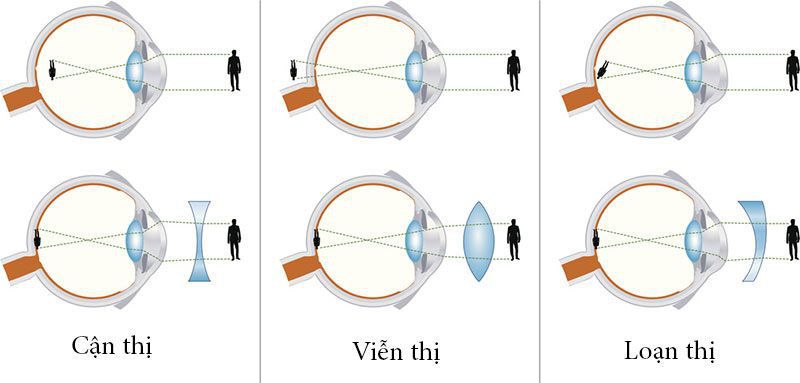 Phân biệt cận thị và viễn thị chính xác đơn giản tại nhà 4